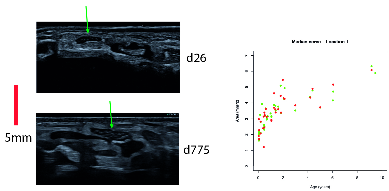 Einsatz hochauflösender Ultraschalltechnik in der Neuropädiatrie