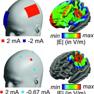 Schematische Darstellung Einer Fokalen Hirnstimulation